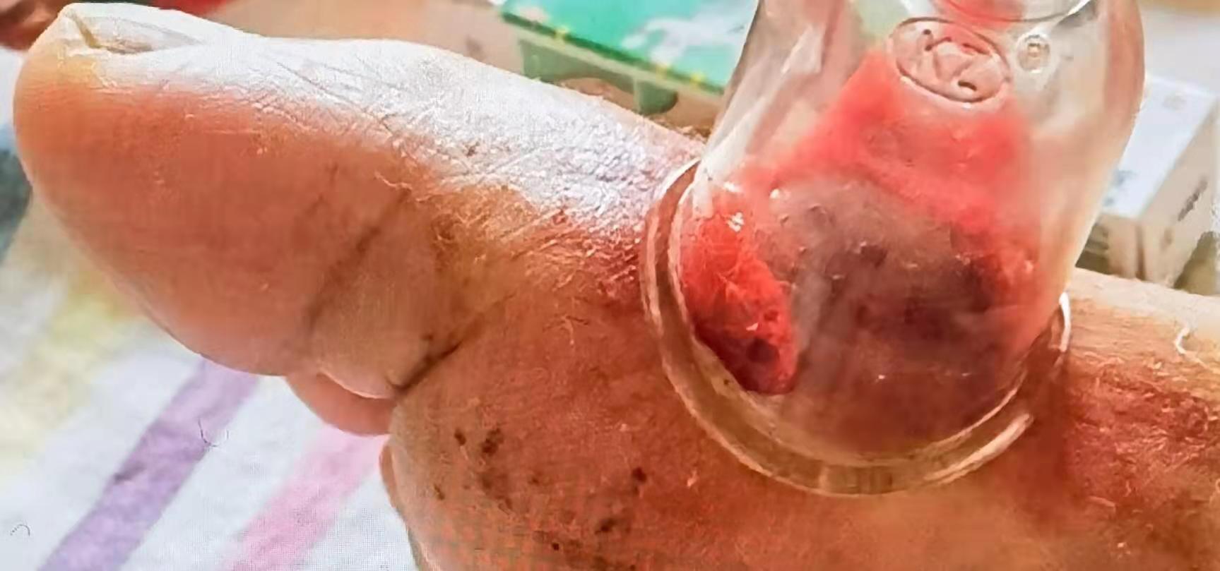 痛风起包怎么解决,快速缓解痛风的小方法