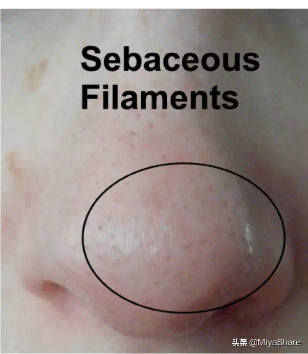 不靠谱的去黑头方法你试过哪几种,真假黑头教你如何正确去黑头