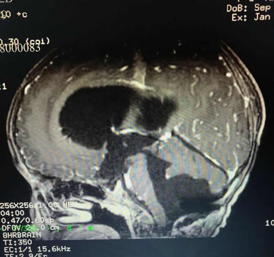 头痛头晕怀疑脑瘤,头痛发现脑癌