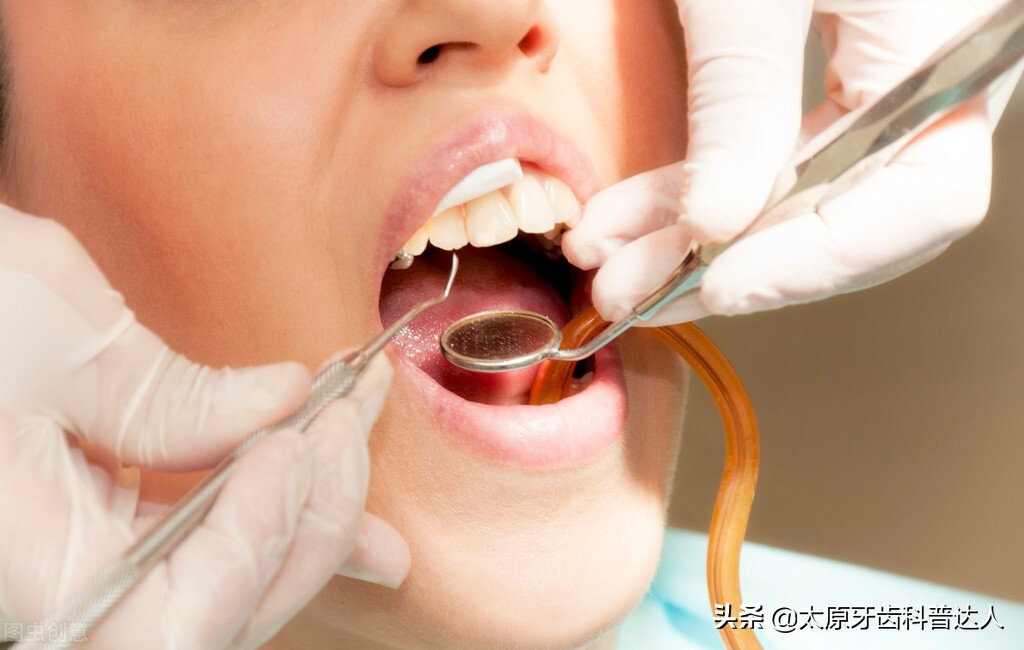 5岁小孩牙齿龋坏了治疗费用,给牙齿涂氟可以预防牙龋坏吗