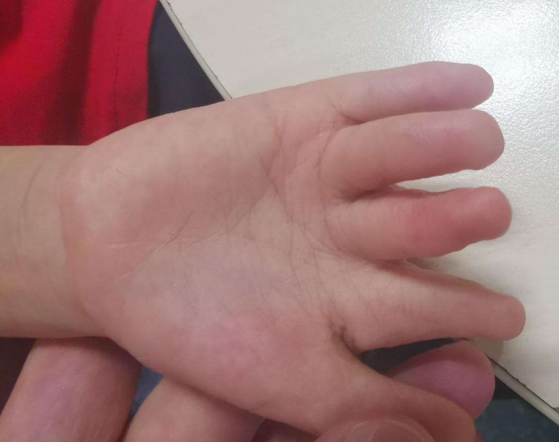 并指畸形免植皮案例,并指畸形