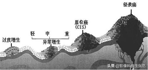 原位癌没有复发会发生转移吗,原位癌未转移可以根治吗
