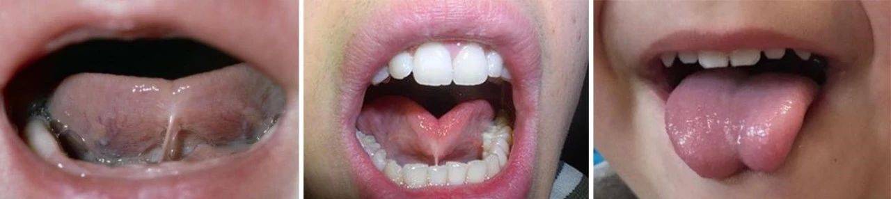 2岁剪舌系带还来得及吗,4岁小孩吐字不清跟舌系带有关吗