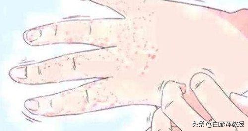 手部湿疹和手癣的鉴别要点主要为,手上起的小疱疹是癣还是湿疹