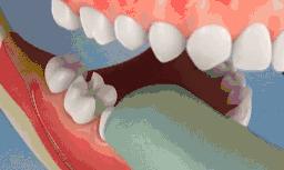 补牙的材料又掉了,补牙用一般材料好还是嵌体好