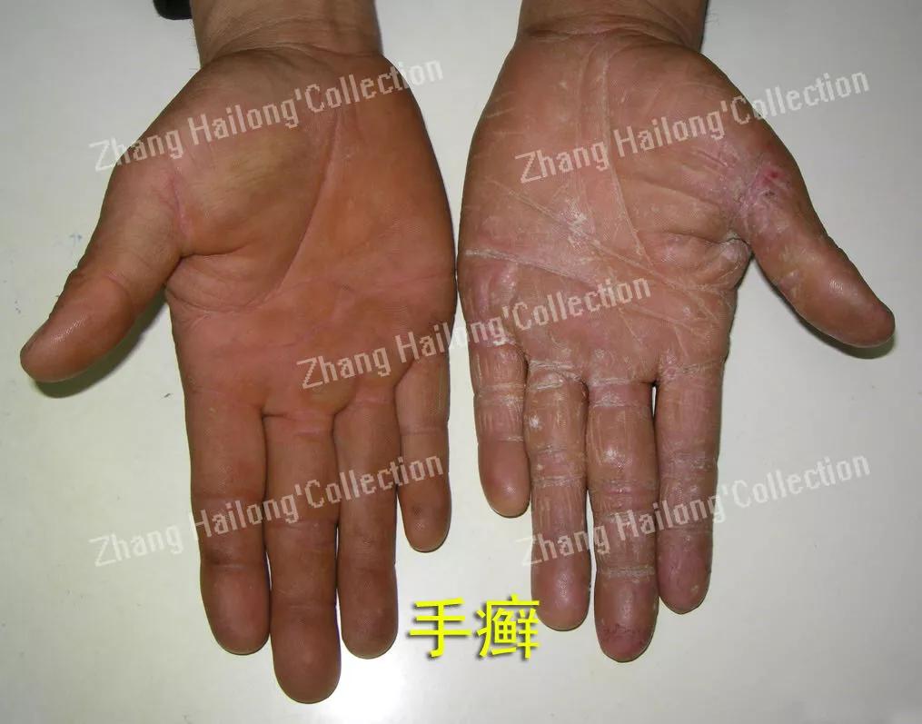 手特别干燥粗糙会是手癣吗,得了手癣指头皮肤变粗糙怎么办