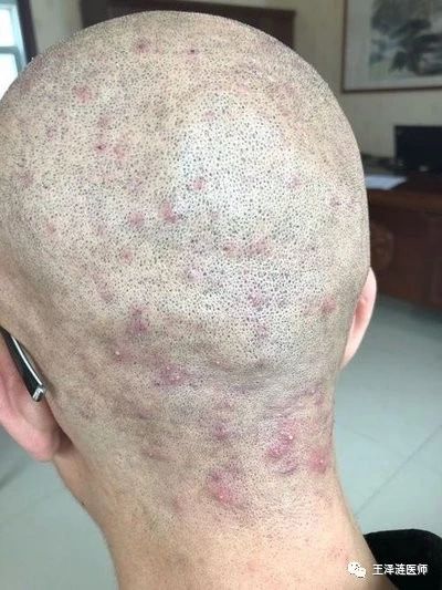 伤口长成红疙瘩是怎么回事,皮肤出现红包是什么原因