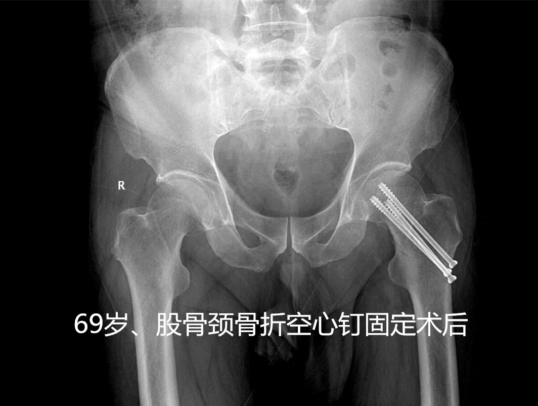 人生最后一次骨折原因,人生的最后一次骨折