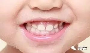 小孩子换牙怎么那么丑,为什么换牙期的宝宝丑