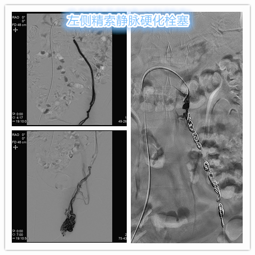 精索静脉曲张介入栓塞死路一条,精索曲张介入栓塞
