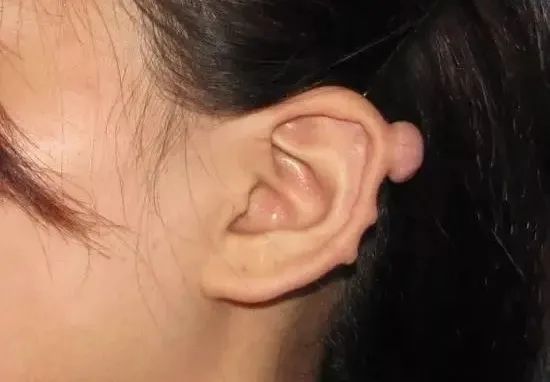 打耳洞打出个肉疙瘩,打耳洞长出肉疙瘩的概率多大