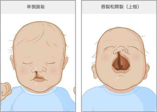 为什么会有兔唇的宝宝,宝宝为什么会长兔唇