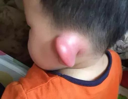 被蚊子咬了什么症状是得病了,被蚊子咬了出现的症状和解决方法