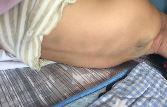 宝宝生下来屁股和脚淤青,宝宝生下来屁股青一大块