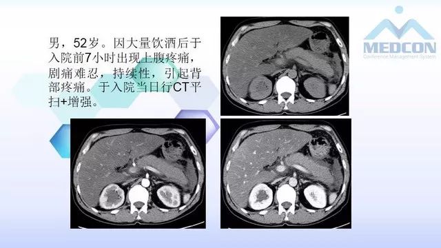 急性胰腺炎的护理措施,急性胰腺炎影像与临床