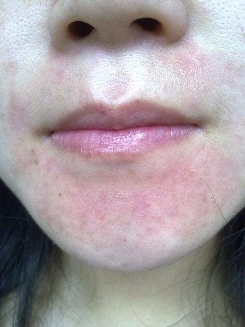 孩子皮肤敏感动不动就过敏怎么办,敏感肌用护肤品后过敏红肿痒灼烧