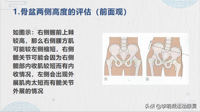 骨盆侧倾的治疗方法,骨盆侧倾最佳的矫正方法