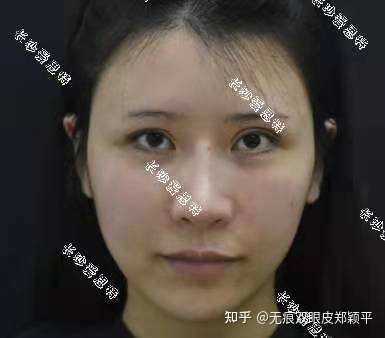 开扇双眼皮6毫米宽吗,双眼皮7.5毫米宽吗