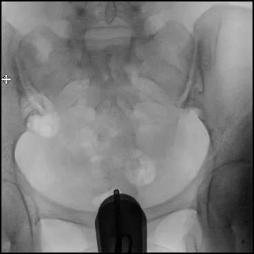 特色诊疗：无痛动态子宫输卵管造影