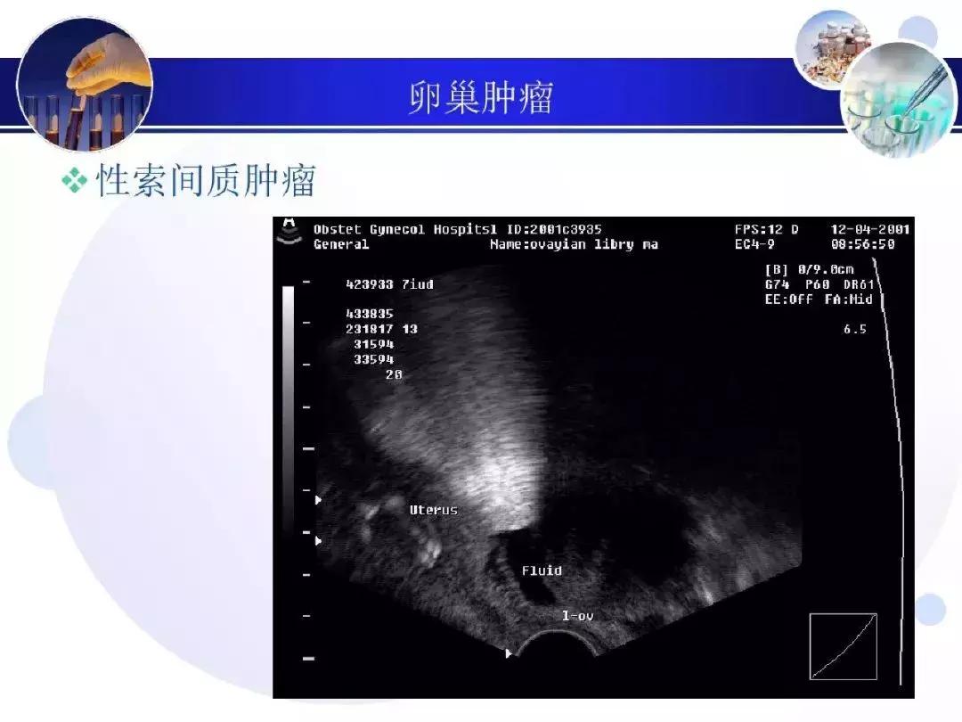 纯干货！子宫及附件解剖和超声诊断