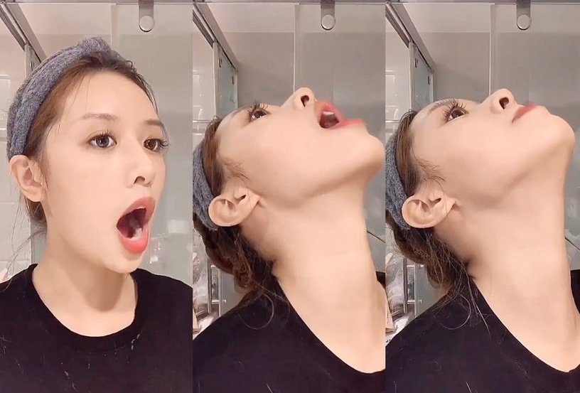 练精致下颚线,徐睿知脸部提升