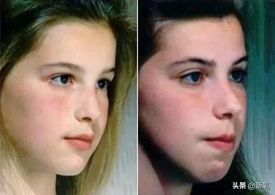 戴牙套真的会出现牙套脸,戴牙套期间牙齿变龅了