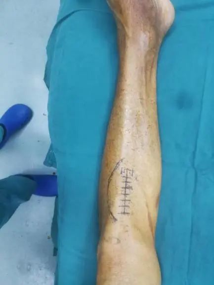 糖尿病足手术后又坏死怎办,糖尿病足部溃烂截肢手术