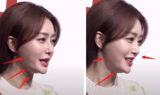 那些一刀切削骨的明星还好吗？后遗症一大堆，小方脸成最大赢家