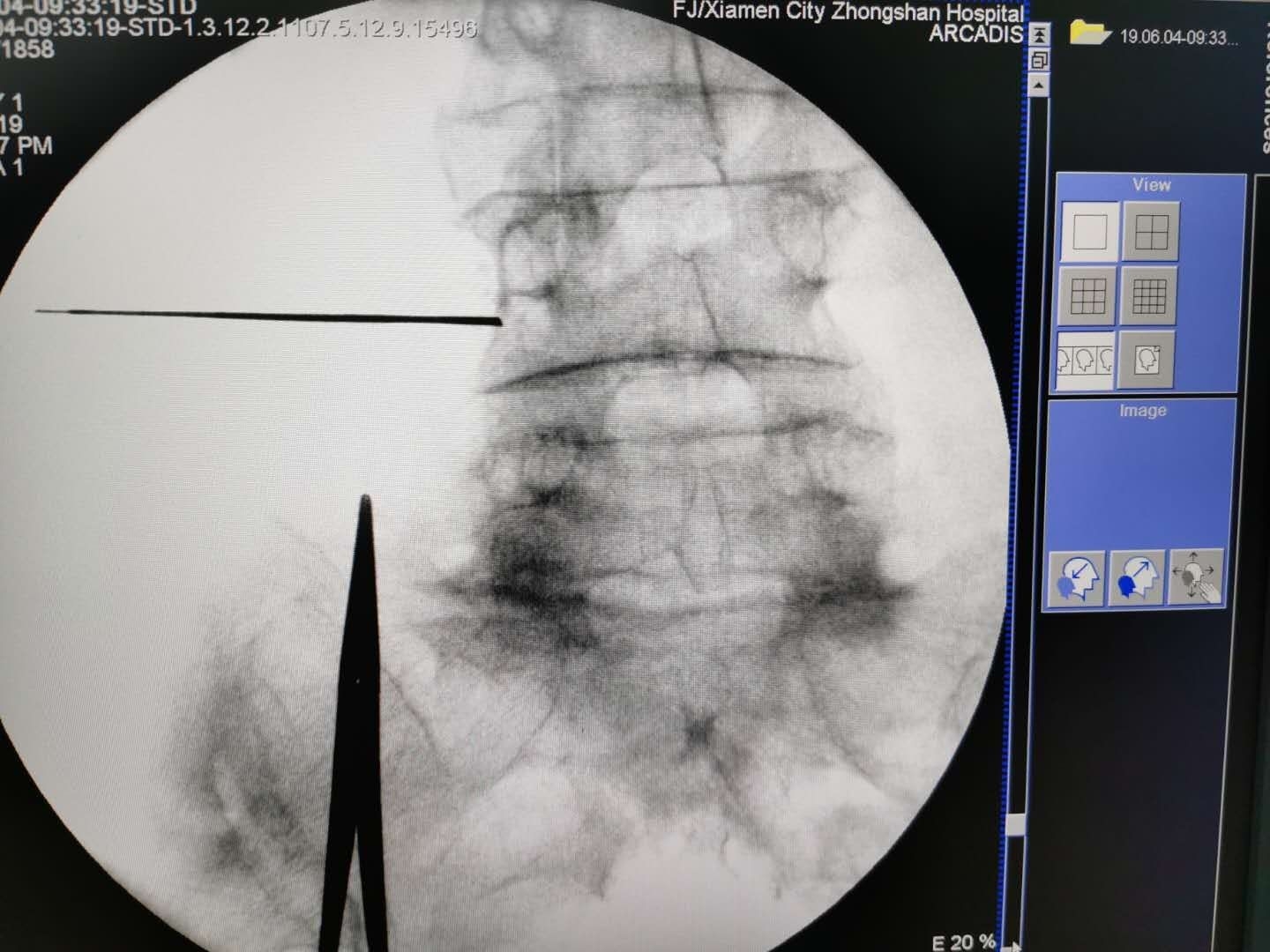 腰痛扎小针刀行吗,腰痛针灸需要吃药嘛