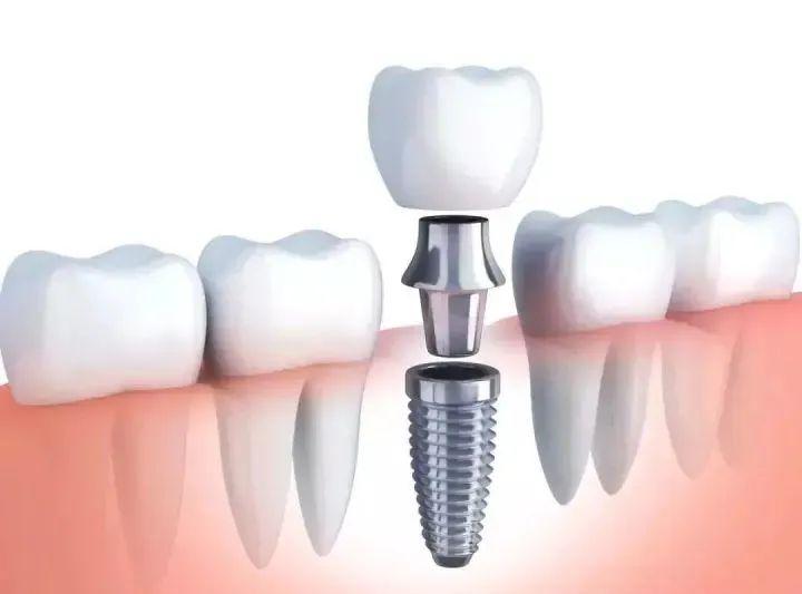 为什么都建议种植牙,种植是目前最好的缺失牙修复方式