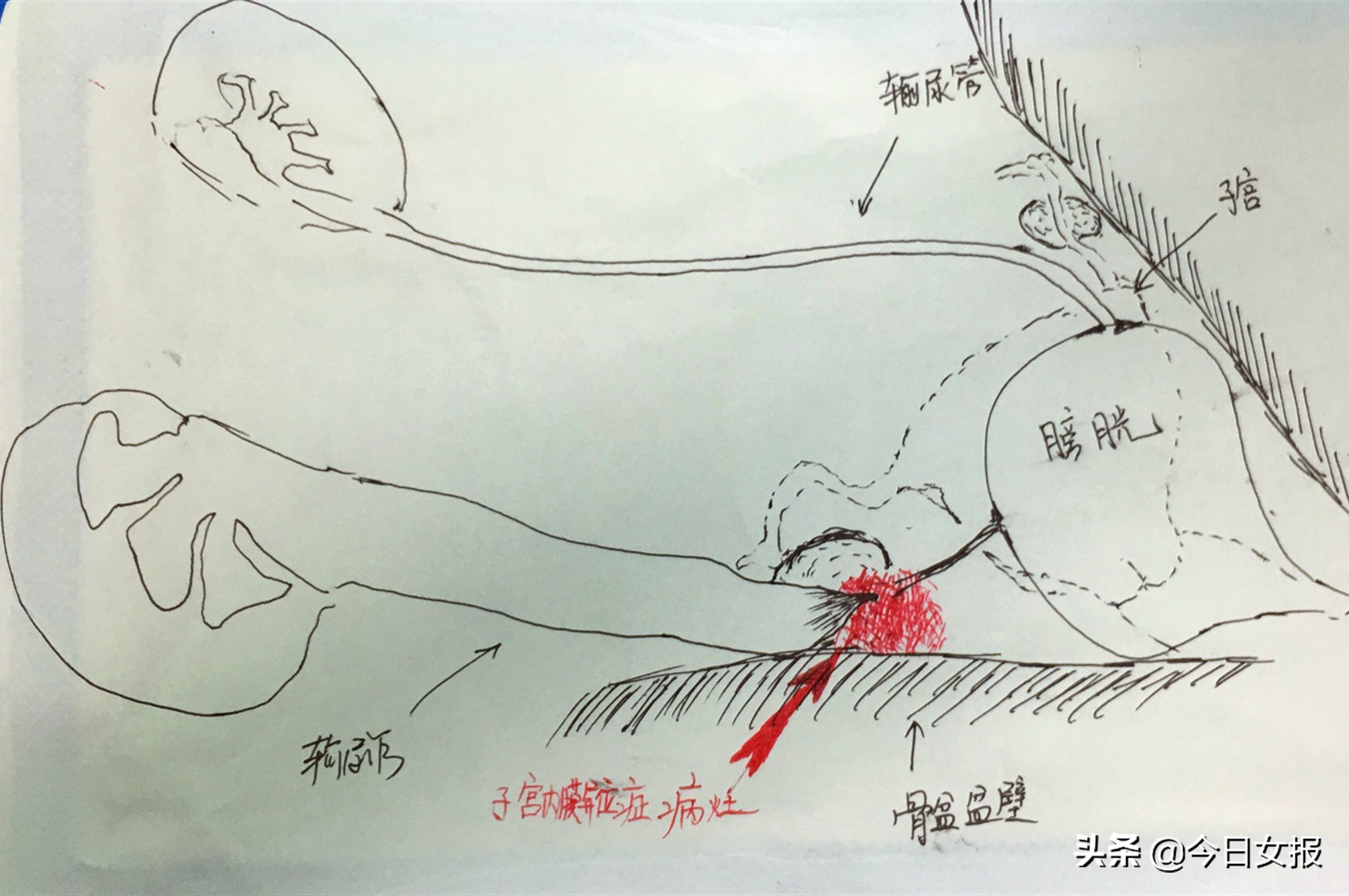 女性腰疼后背疼肾积水,40岁女性腰疼右肾积水