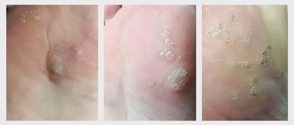 脚上的跖疣是瘊子吗,跖疣和刺瘊怎么感染的