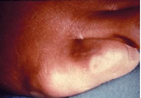 小脚趾拇囊炎的治疗方法,小脚趾侧边肿痛用什么药