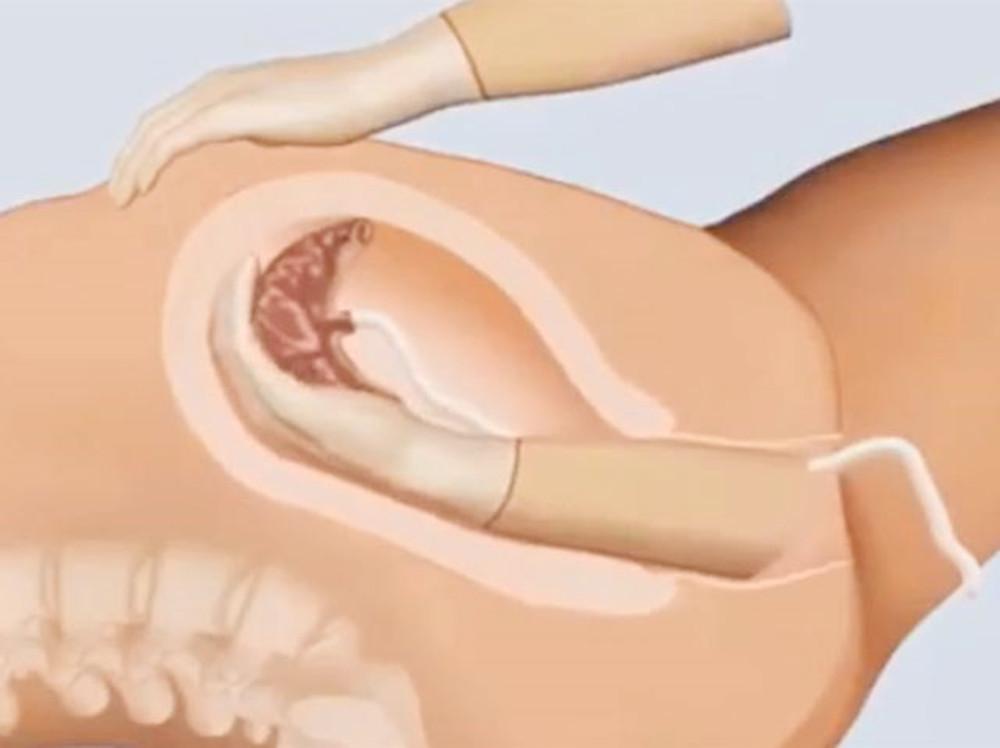 分娩产程的三大阶段,分娩时的产道