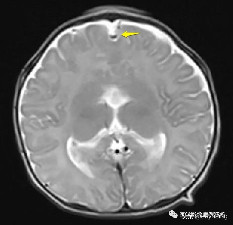 半叶全前脑畸形,无叶型前脑无裂畸形超声表现