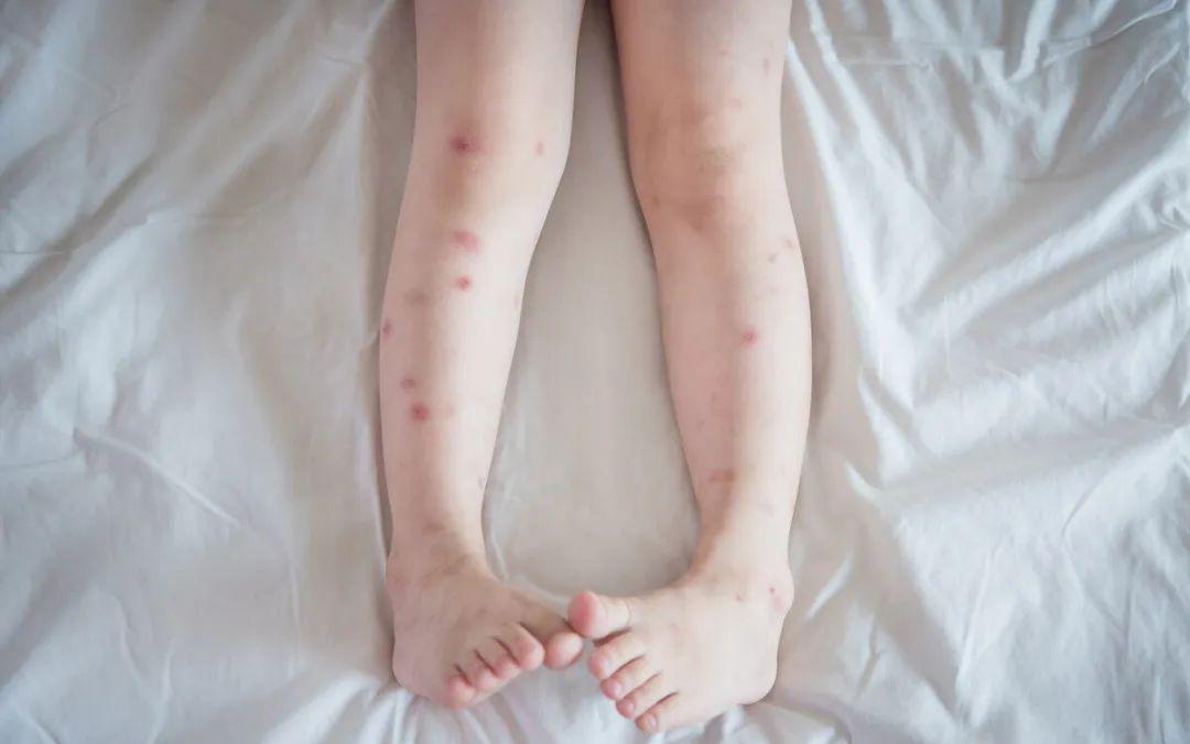 蚊虫叮咬怎么止痒最快最有效办法,夏天蚊虫叮咬止痒最有效的方法