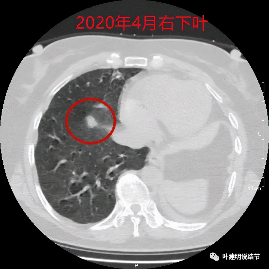 左肺癌手术半年右肺下角还有炎症,左下肺癌晚期