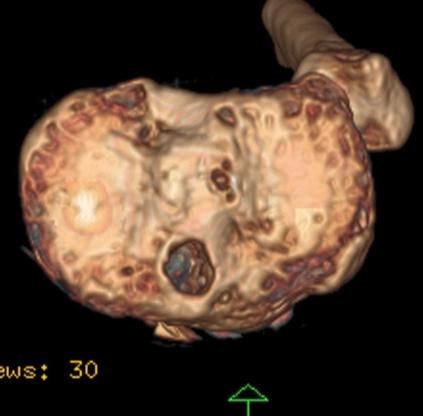 关节手术后康复训练弯不了怎么办,手术关节僵硬三个月了可以恢复吗