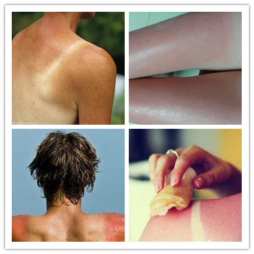 紫外线晒皮肤发红怎么办,紫外线晒得又红又痒怎么办