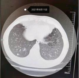 “旧病未愈，又添新症”，9.9mm高危肺结节，手术不犹豫