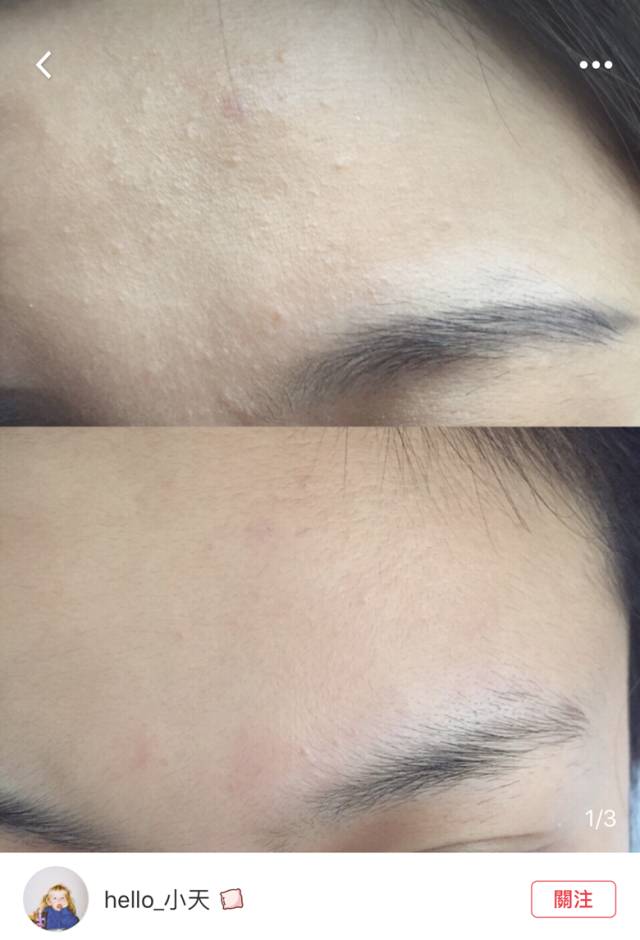 烂脸适合的护肤水,烂脸最好用的护肤品