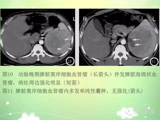 脾血管瘤中医辨证,脾血管瘤超声表现