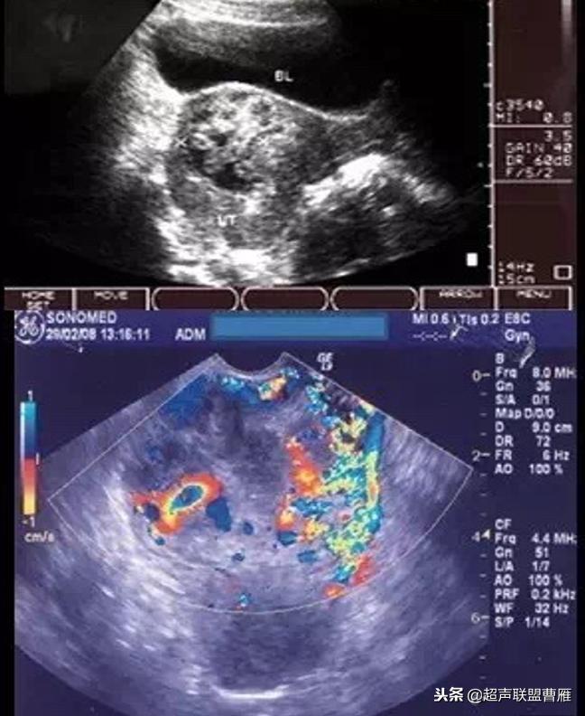 剖宫产疤痕妊娠几率,剖宫产疤痕妊娠及其护理