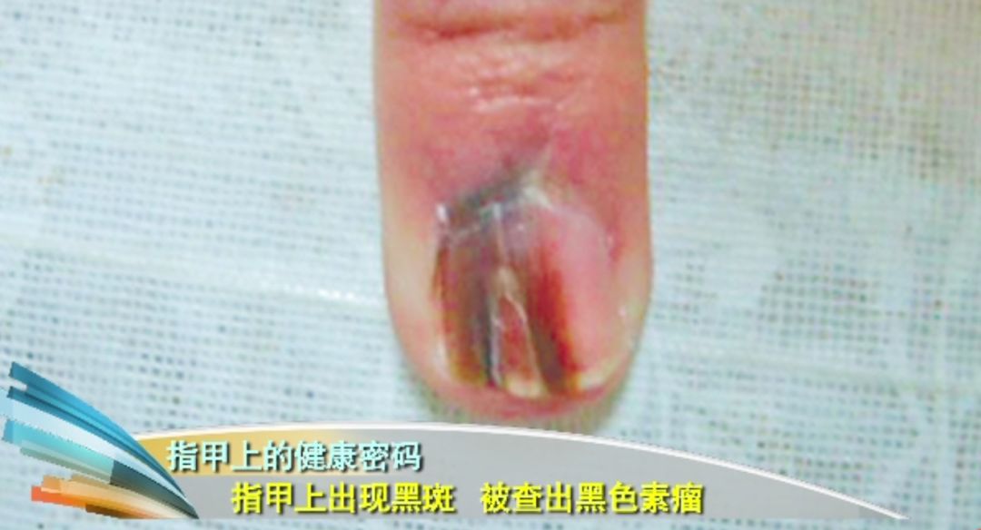 指甲有四种现象很危险,指甲反映身体状况