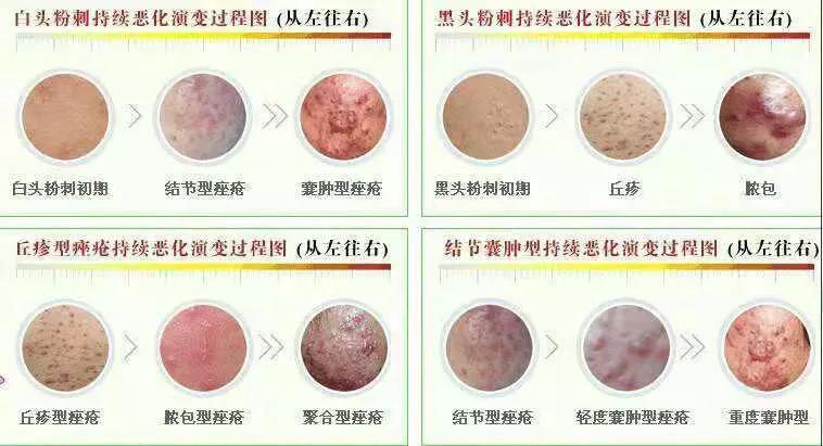 怎么解决糟心的黑头,怎么才能看清楚自己脸上的黑头