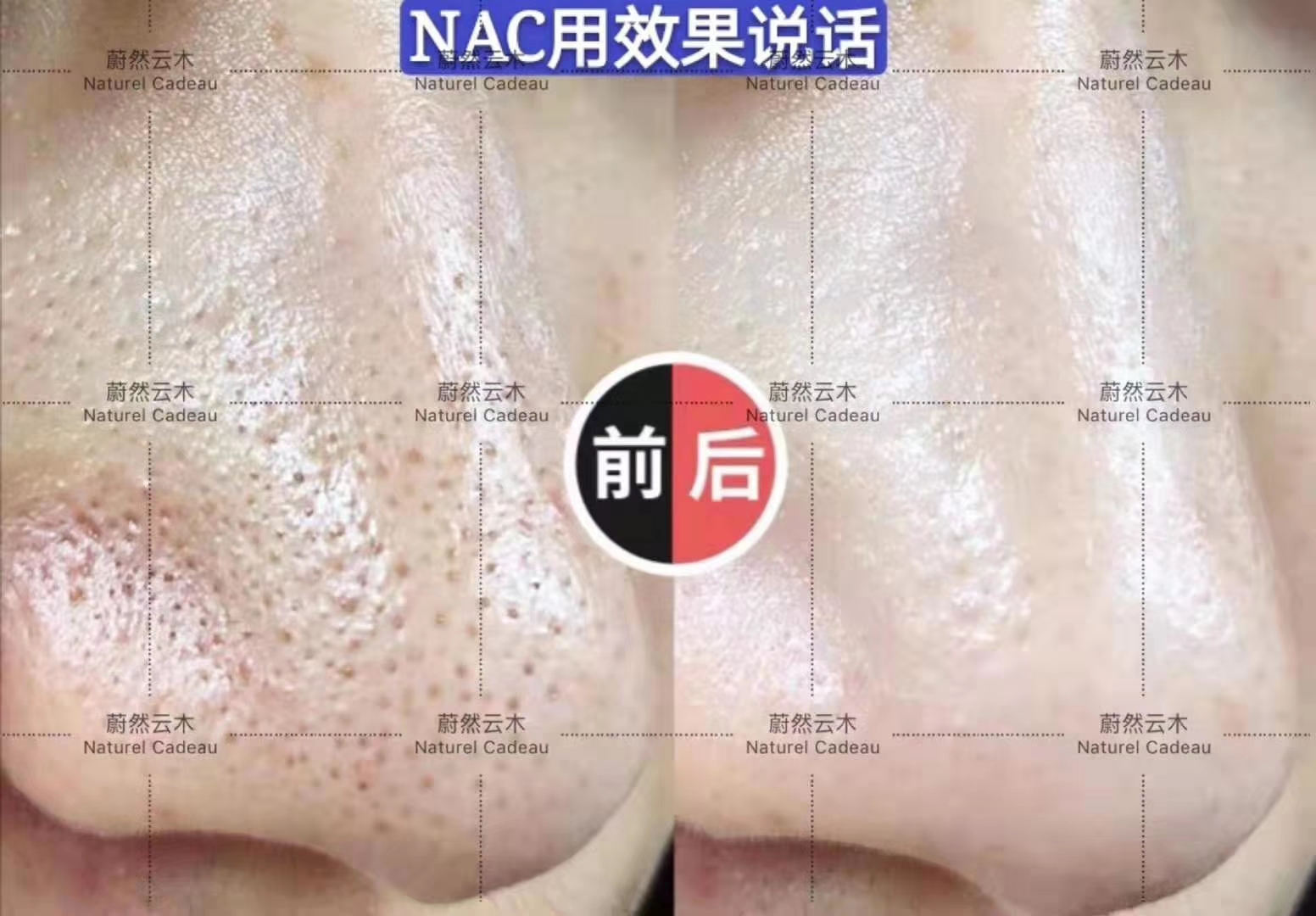 毛孔粗大如何改善用什么护肤品,毛孔粗大如何改善男生最快的办法