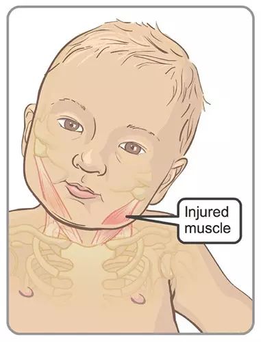 宝宝斜颈可以使用什么物理疗法,纠正宝宝斜颈最好的办法