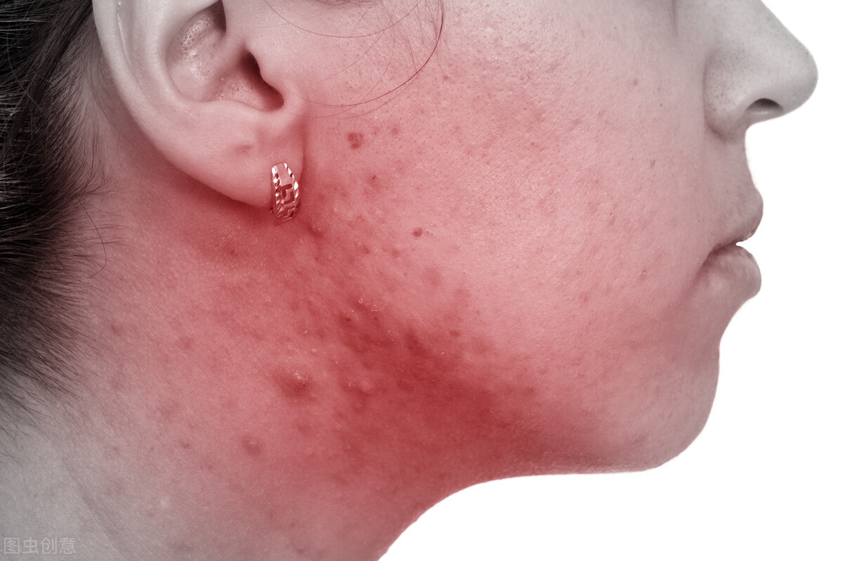 疮疤性痤疮,玫瑰痤疮早期怎么治