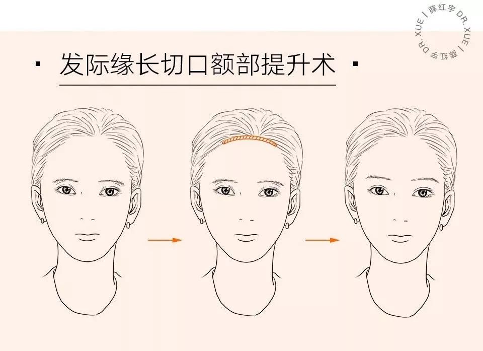 眼部抗衰最好方法,眼部抗衰效果图