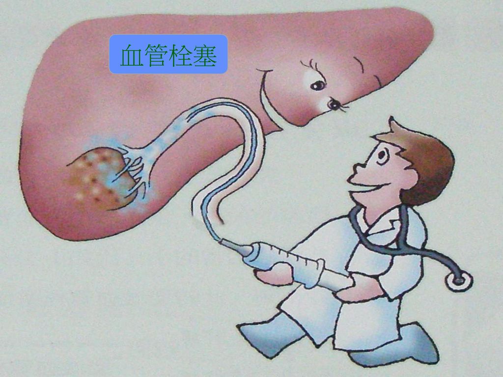 抗病毒后进展为肝硬化的几率大吗,抗病毒治疗后乙肝有传染性么